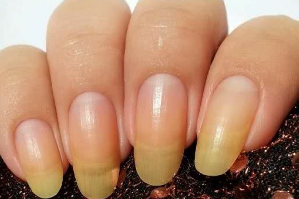 Почему желтеют ногти на руках - основные причины и рекомендации 1