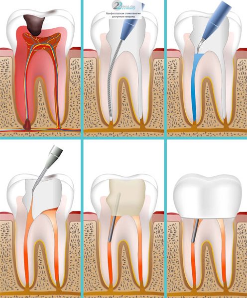 Как спасти зуб с гнойным периодонтитом 1
